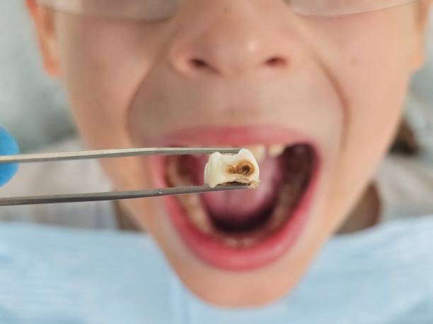 Best Emergency Treatment for Dental Infections or Abscesses in Dawson Springs, KY